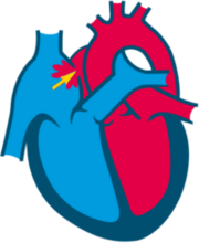 Patent Foramen Ovale