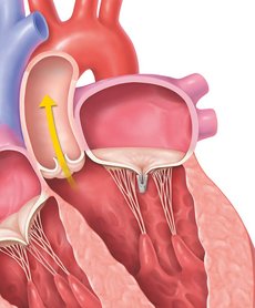 Transcatheter Mitral Valve Repair Step 5