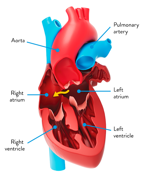 how ASD affects blood flow