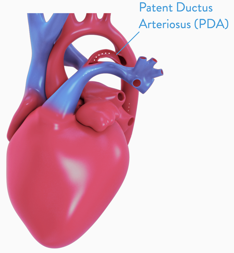 Device Closure Procedure, ASD, VSD, PDA