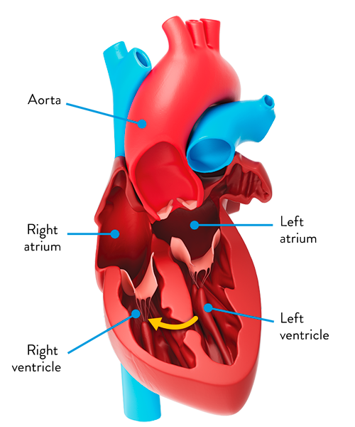 how VSD affects blood flow