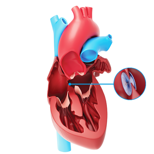 Atrial Septal Defect Treatment Options 