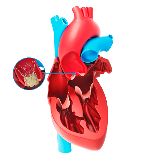 Aortic Stenosis Treatment