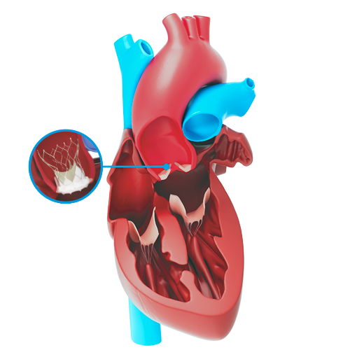 Aortic Stenosis Treatment Aortic Stenosis Treatment