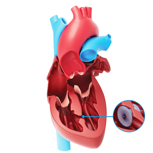 Ventricular Septal Defect treatment options