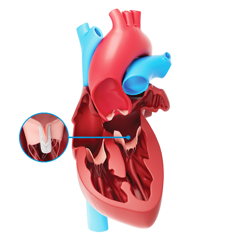 Treatment option for Mitral Regurgitation